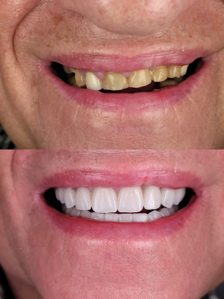 Before and after: Full Smile Makeover