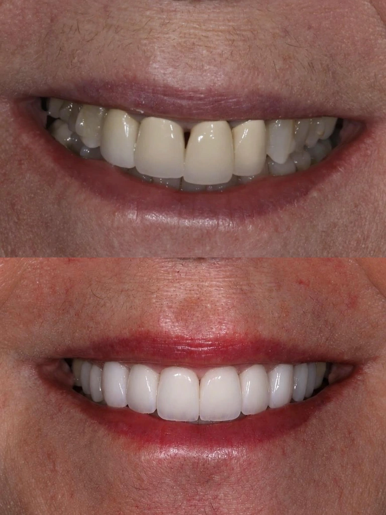 Before and after: Veneers + Crowns