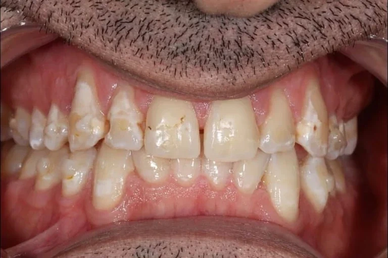 1-invisalign-upper-veneers-before
