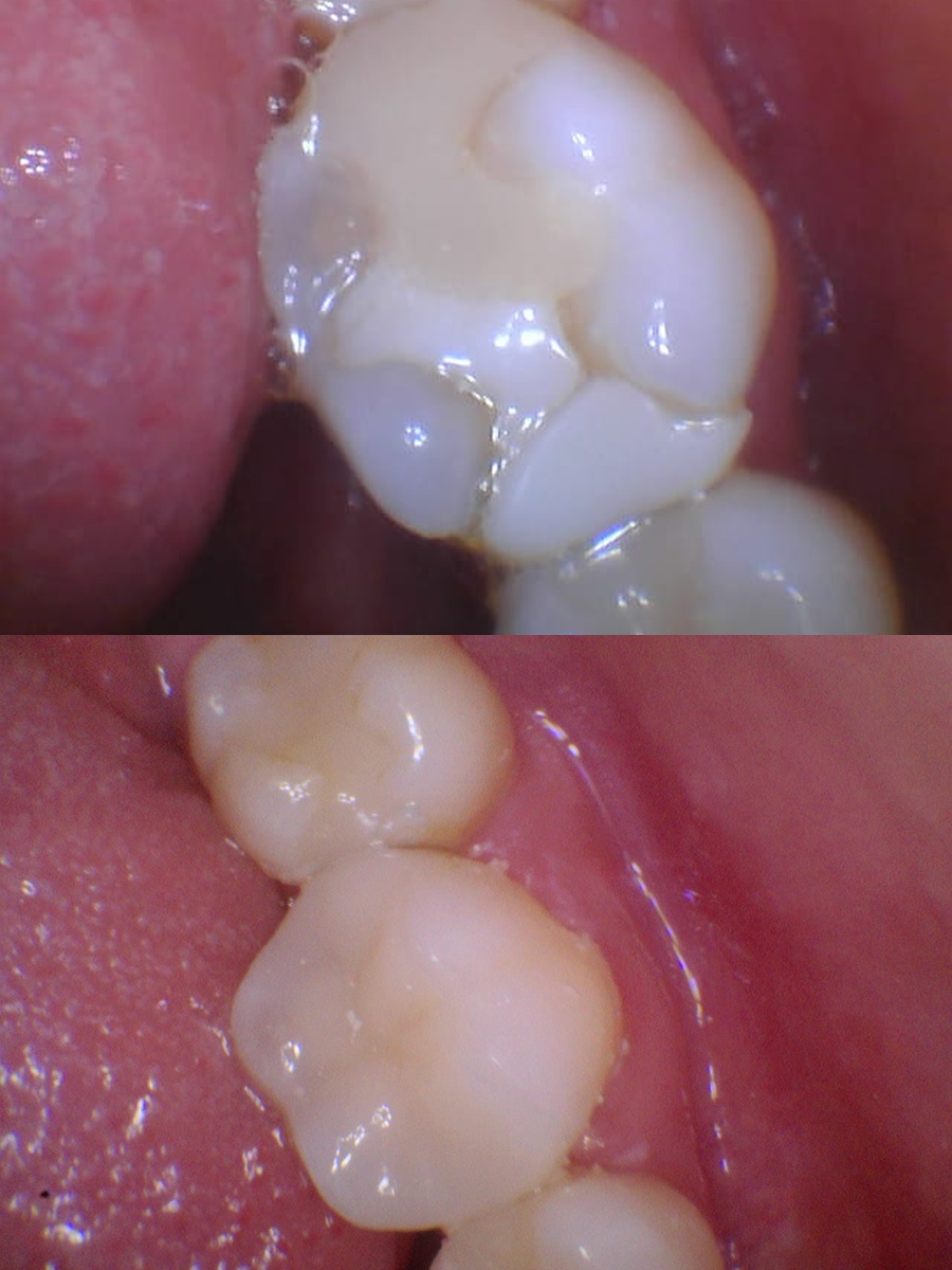 Before and after: Tooth-Colored Restoration