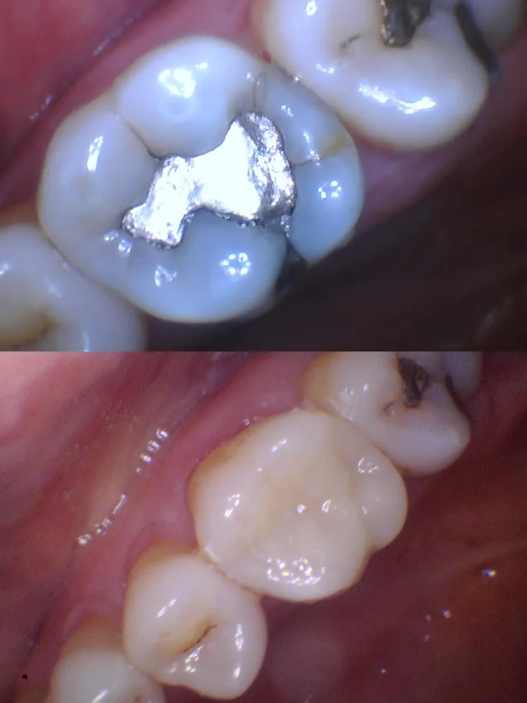 Before and after: Onlay