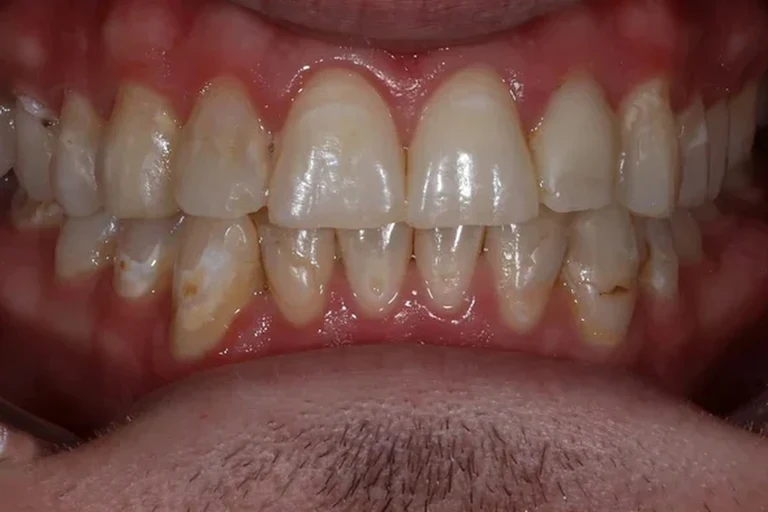 1-porcelain-veneers-zoom-before