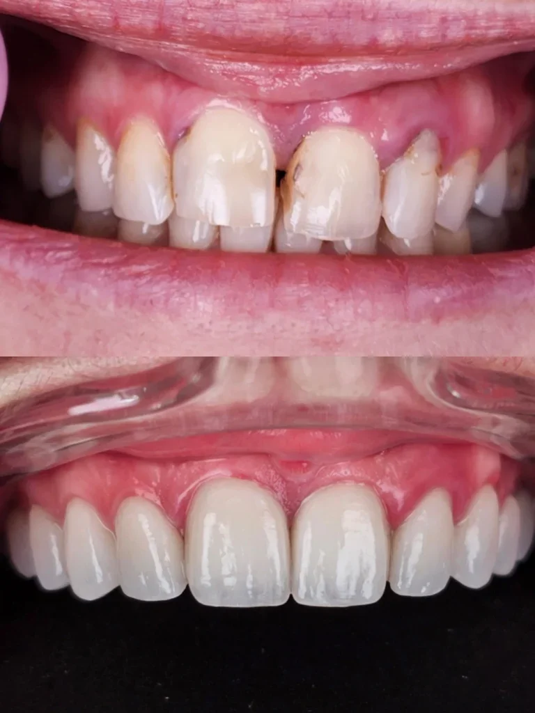Before and after: Smile Refresh