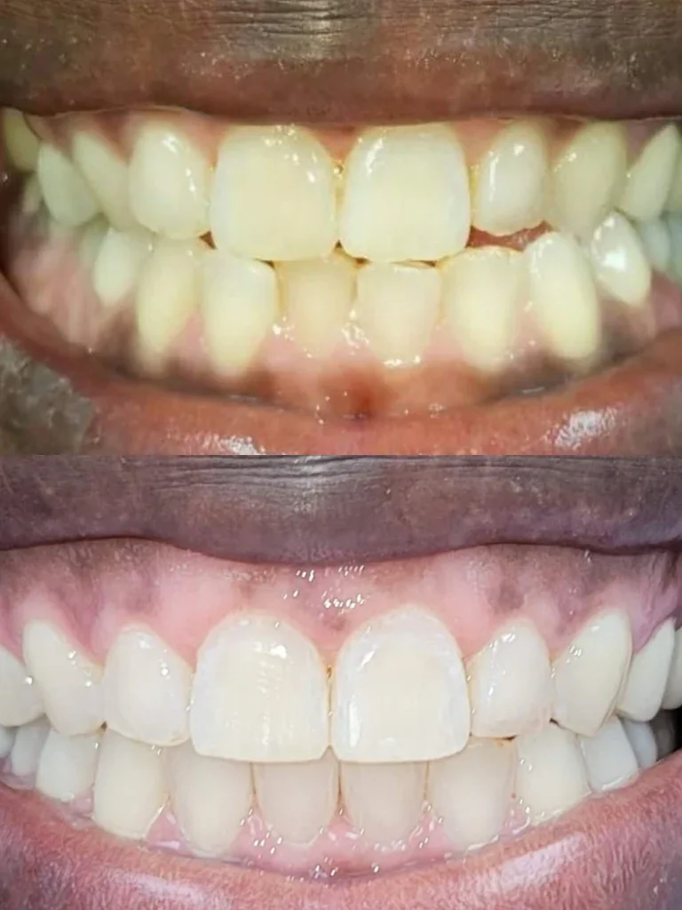 Before and after: Brighter, Even Smile