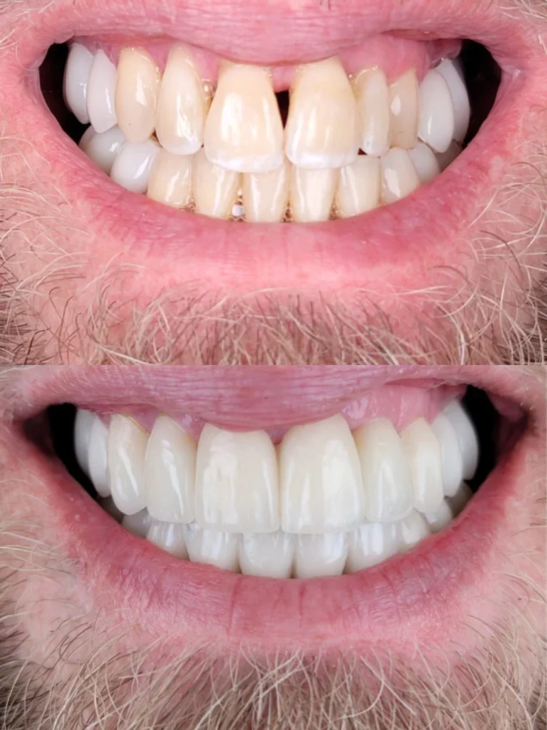 Before and after: Closing Gaps