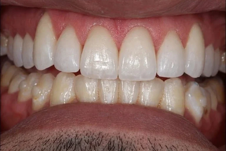 2-invisalign-upper-veneers-after