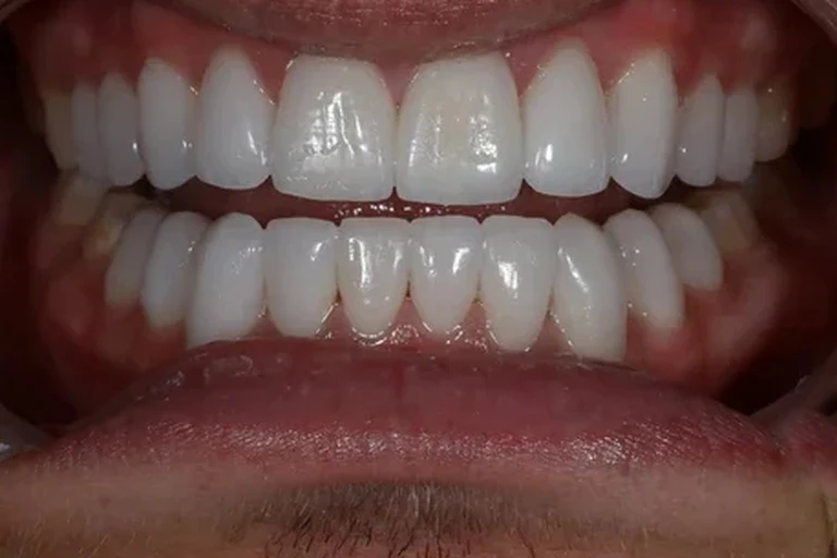 2-porcelain-veneers-zoom-after