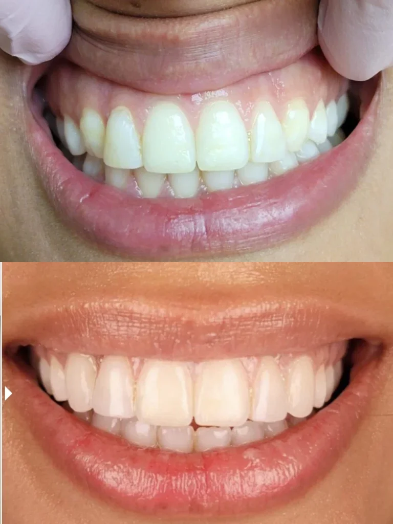 Before and after: Smile Brightening