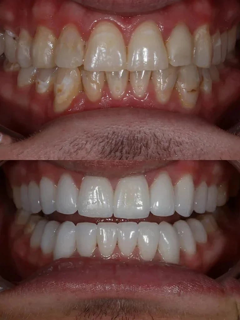 Before and after: Porcelain Veneers