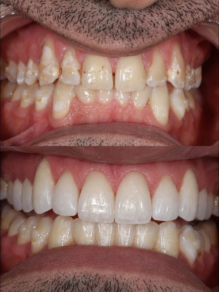 Before and after: Invisalign + Upper Veneers