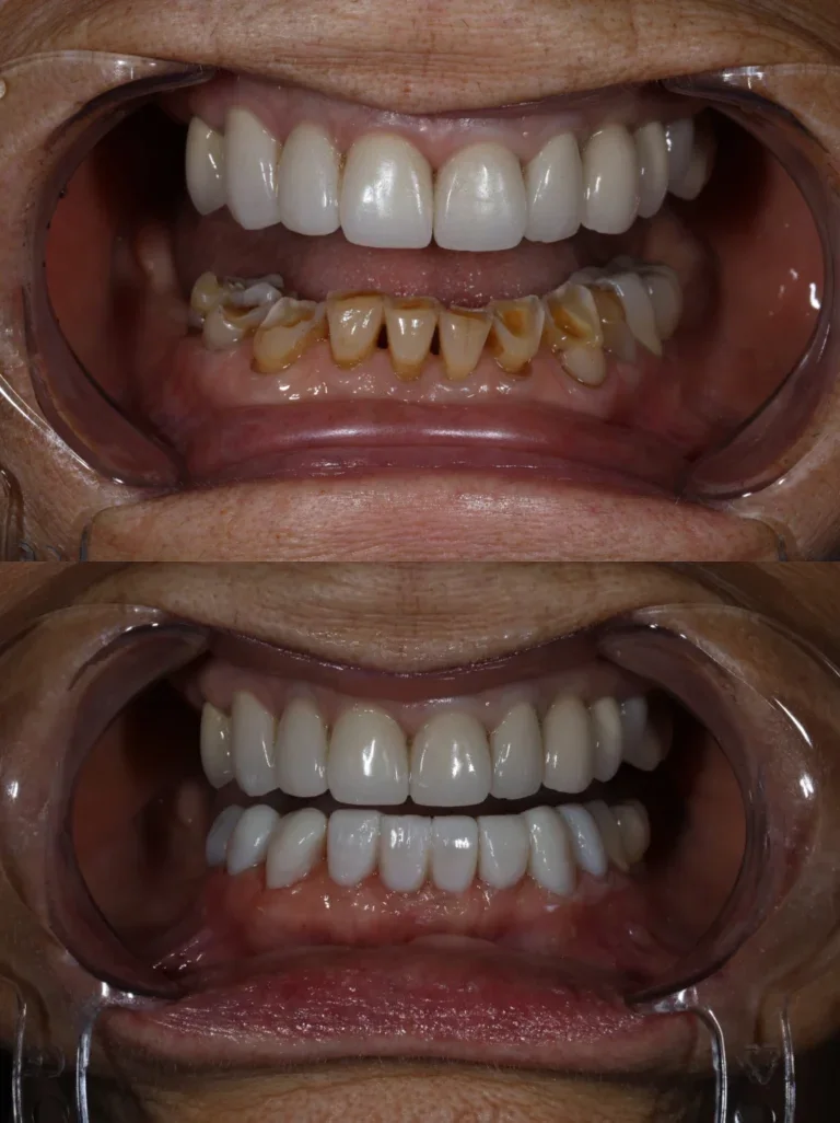 Before and after: Lower Arch Restoration