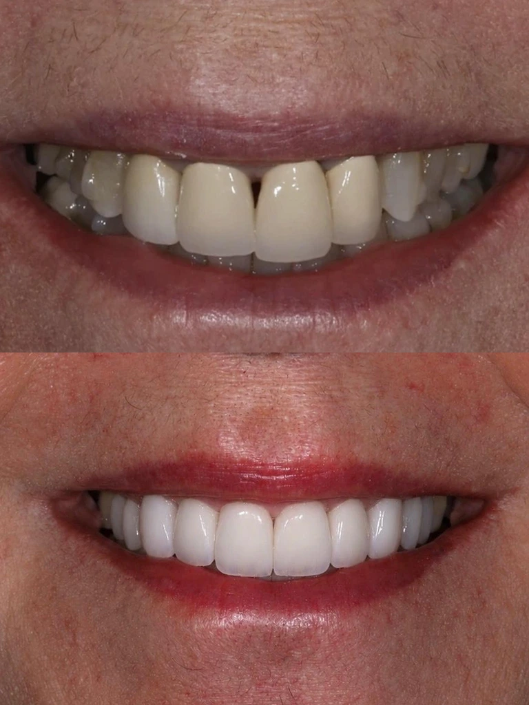 Before and after: front gap closed with veneers and crowns