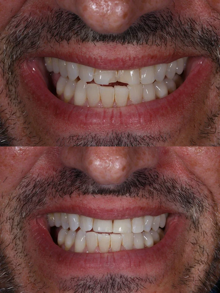 Before and after: Chipped Tooth Repair
