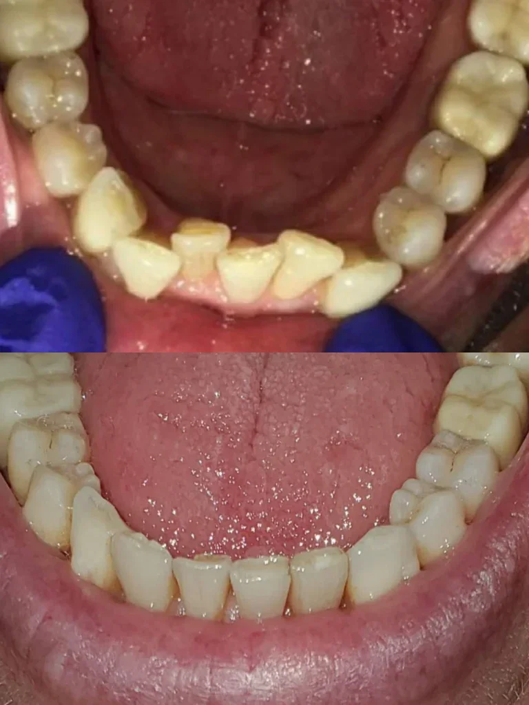 Before and after: Lower Smile Renewal