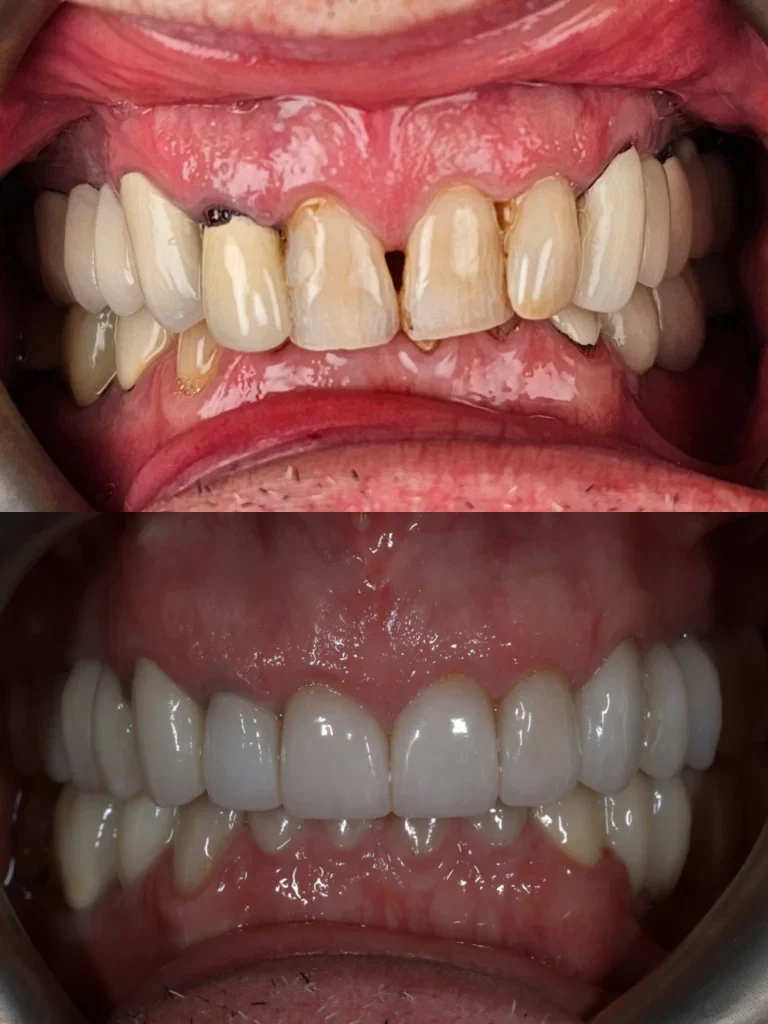 Before and after: Smile Makeover