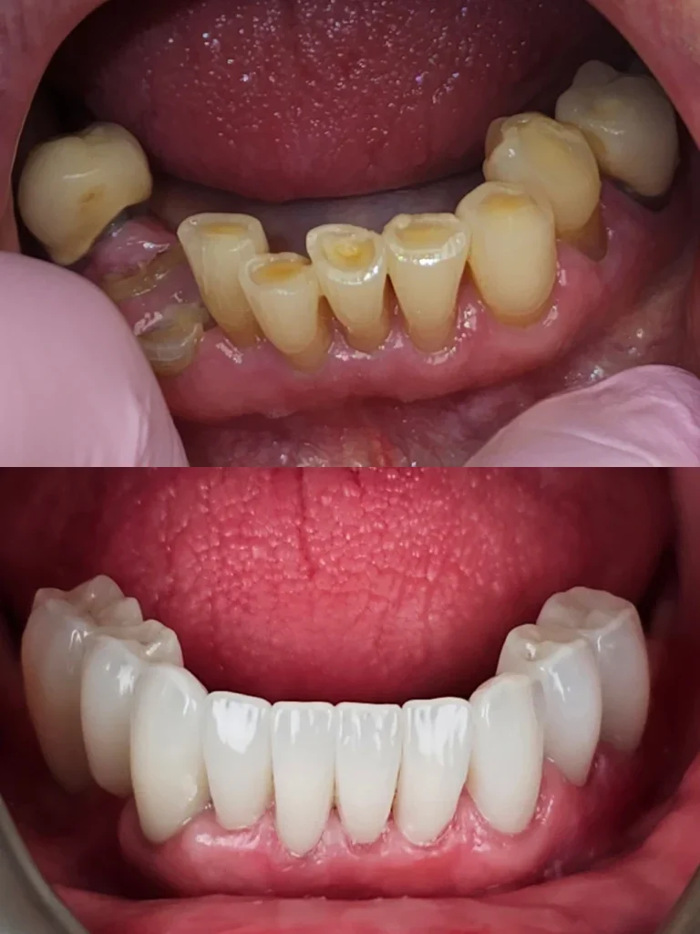 Before and after: Lower Arch Rebuild