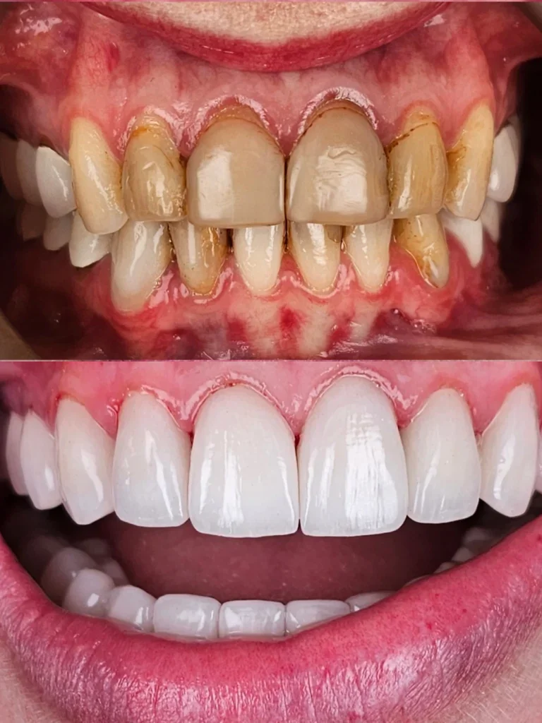 Before and after: Complete Smile Makeover